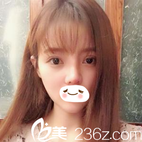 术后第十天效果 术后第十天效果