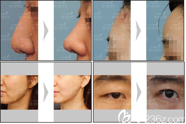 韩国延世Saint整形外科案例 韩国延世Saint整形外科案例