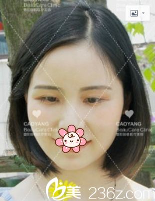 想不到我这种顽固的泪沟型眼袋重庆曹阳丽格美容医院也给弄好了！