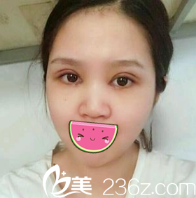 术后第四天样子 术后第四天样子