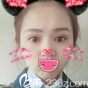 术后一周拆线 术后一周拆线