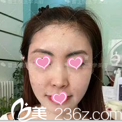 脸部脂肪填充后35天的样子