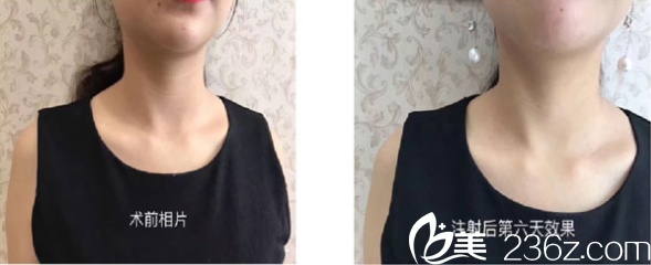 祛颈纹案例1 祛颈纹案例1