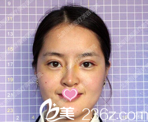 韩式双眼皮韩式隆鼻术后第十天的样子