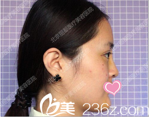 在丽都做双眼皮隆鼻术后二十八天的样子