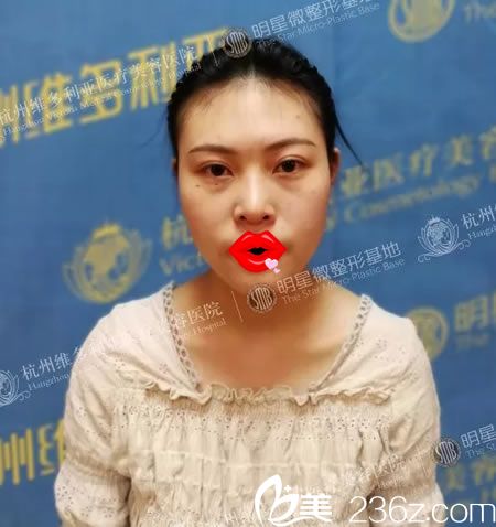 做自体脂肪填充前的大饼脸 做自体脂肪填充前的大饼脸