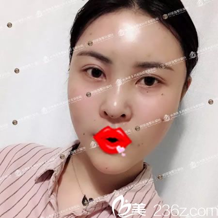 找维多利亚马腾做脂肪填充后即刻照片 找维多利亚马腾做脂肪填充后即刻照片