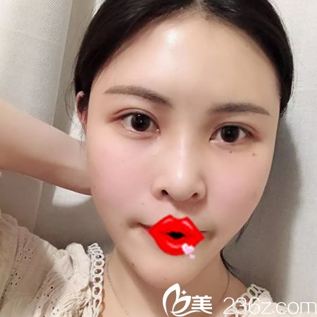 杭州维多利亚自体脂肪填充案例5天效果 杭州维多利亚自体脂肪填充案例5天效果