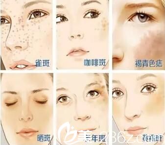 激光可以改善斑点的类型 激光可以改善斑点的类型