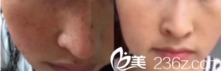 韩国Mybeauti整形外科医院案例 韩国Mybeauti整形外科医院案例