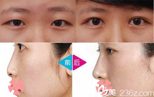 泉州东大双眼皮和鼻综合隆鼻<span style= 泉州东大双眼皮和鼻综合隆鼻<span style=