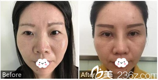深圳香蜜丽格刘美佳子医生做的膨体隆鼻和双眼皮案例