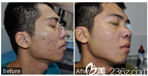 广东药科<!--<i data=20240709-sp></i>-->广州复星禅诚医院皮肤科皮肤疤痕科巫尾英医生激光祛除痘坑实例 广东药科<!--<i data=20240709-sp></i>-->广州复星禅诚医院皮肤科皮肤疤痕科巫尾英医生激光祛除痘坑实例