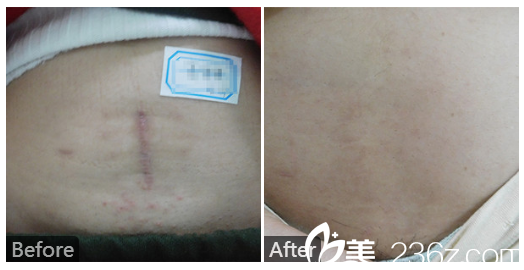 广东药科<!--<i data=20240709-sp></i>-->广州复星禅诚医院皮肤科皮肤科巫尾英怎么样?看看剖腹产疤痕祛除实例 广东药科<!--<i data=20240709-sp></i>-->广州复星禅诚医院皮肤科皮肤科巫尾英怎么样?看看剖腹产疤痕祛除实例