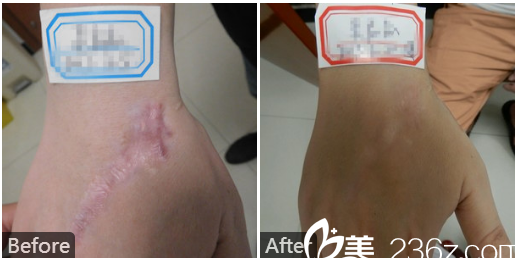 广东药科<!--<i data=20240709-sp></i>-->广州复星禅诚医院皮肤科皮肤疤痕科巫尾英手背疤痕修复实例 广东药科<!--<i data=20240709-sp></i>-->广州复星禅诚医院皮肤科皮肤疤痕科巫尾英手背疤痕修复实例