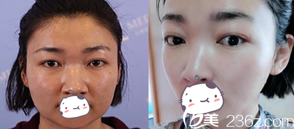 合肥白领安琪儿瘦脸除皱前后对比效果图 合肥白领安琪儿瘦脸除皱前后对比效果图