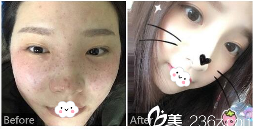 广东药科<!--<i data=20240709-sp></i>-->广州复星禅诚医院皮肤科皮肤疤痕科巫尾英医生巫尾英皮秒激光祛斑实例 广东药科<!--<i data=20240709-sp></i>-->广州复星禅诚医院皮肤科皮肤疤痕科巫尾英医生巫尾英皮秒激光祛斑实例