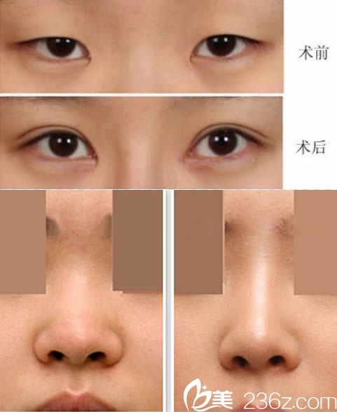 泉州东大陈逸华韩式双眼皮和鼻综合隆鼻案例图