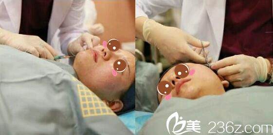 上海美莱医疗美容医院邱阳面部埋线提升真人案例术中照
