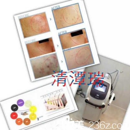 医院IPL项目治疗皮肤问题 医院IPL项目治疗皮肤问题