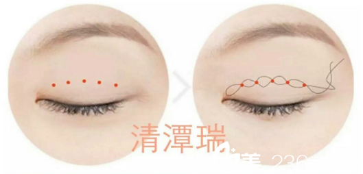 李奎㬚发明“SNS自然粘连法”术式 李奎㬚发明“SNS自然粘连法”术式