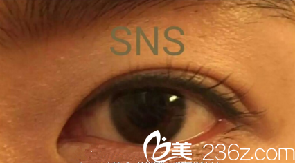 “SNS自然粘连法”双眼皮效果