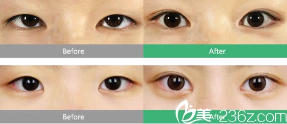 泉州东大双眼皮和上睑下垂矫正案例图 泉州东大双眼皮和上睑下垂矫正案例图