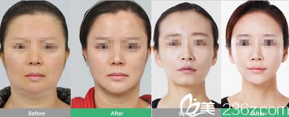 全脸线雕提升和自体脂肪填充全面部前后对比照 全脸线雕提升和自体脂肪填充全面部前后对比照