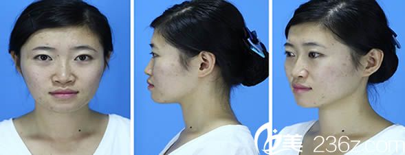 在泉州东大整形医院做综合隆鼻术前照 在泉州东大整形医院做综合隆鼻术前照