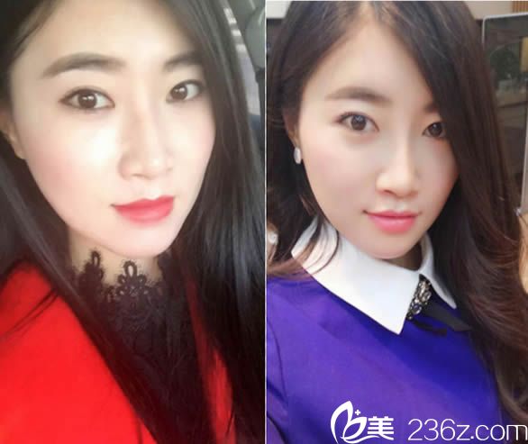 我感觉泉州东大整形医院挺正规的，就去找裴彦鹏做了自体肋软骨鼻综合隆鼻