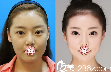 郑润载院长眼角修复案例 郑润载院长眼角修复案例