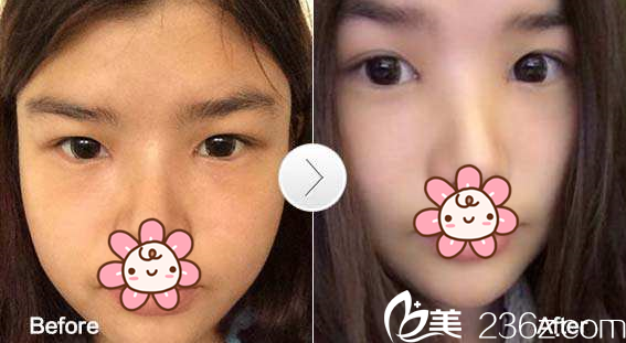 郑润载院长开内眼角案例 郑润载院长开内眼角案例