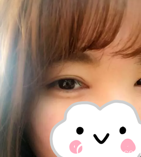 手术后第20天 手术后第20天