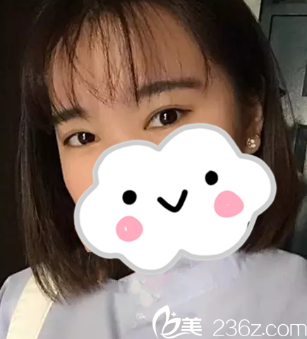 邵阳曹家美容整形医院双眼皮怎么样？真人案例