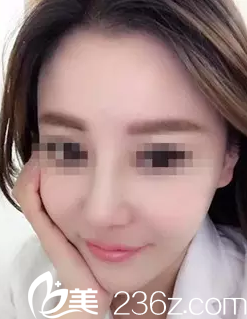 术后半个月 术后半个月