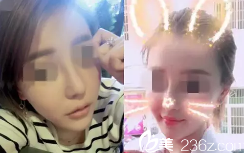 邵阳德美医生改变了我塌鼻梁，大鼻头，让我重新提高了气质