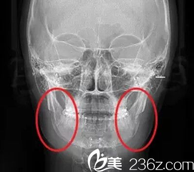 下颌角手术术后注意事项 下颌角手术术后注意事项