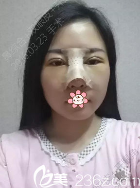 四天了，还是有点肿