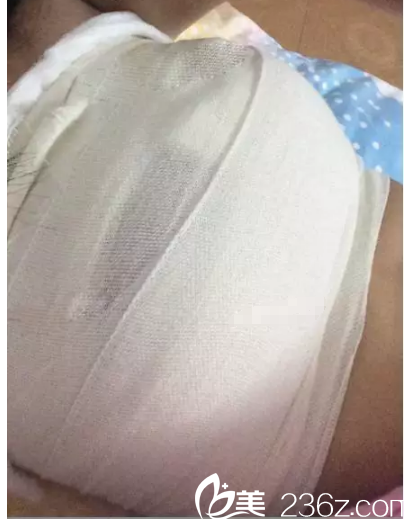 刚做完假体隆胸手术 刚做完假体隆胸手术