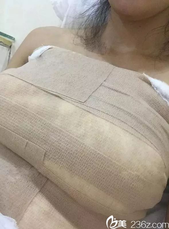 术后五天假体恢复中 术后五天假体恢复中