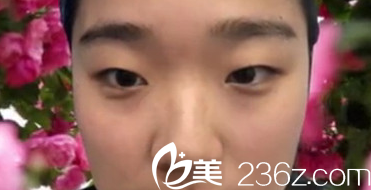 太原华美双眼皮+鼻综合术前照片 太原华美双眼皮+鼻综合术前照片