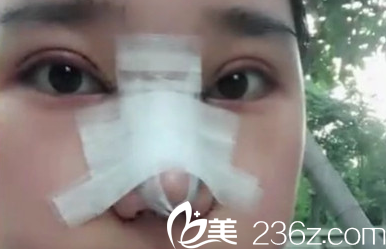 太原华美双眼皮+鼻综合手术后第3天照片 太原华美双眼皮+鼻综合手术后第3天照片