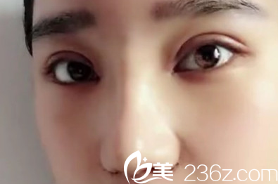 太原华美<!--<i data=20240703-sp></i>-->鼻综合+双眼皮术后第7天照片 太原华美<!--<i data=20240703-sp></i>-->鼻综合+双眼皮术后第7天照片