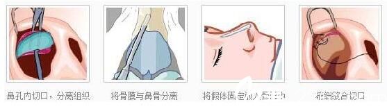 假体隆鼻手术过程