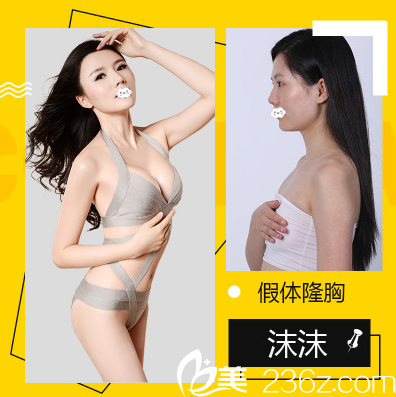 深圳鹏爱秀琪医疗美容医院谭涛院长假体隆胸案例 深圳鹏爱秀琪医疗美容医院谭涛院长假体隆胸案例