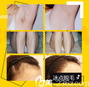 深圳鹏爱秀琪医疗美容医院冰点脱毛案例 深圳鹏爱秀琪医疗美容医院冰点脱毛案例