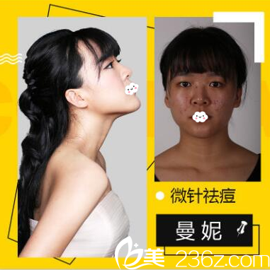 深圳鹏爱秀琪医疗美容医院刘亚慧微针祛痘案例 深圳鹏爱秀琪医疗美容医院刘亚慧微针祛痘案例