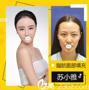 深圳鹏爱秀琪医疗美容医院薛林兵自体脂肪面部填充全脸案例 深圳鹏爱秀琪医疗美容医院薛林兵自体脂肪面部填充全脸案例