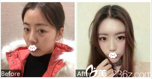 深圳鹏爱秀琪医疗美容医院石东文自体脂肪面部全脸填充案例 深圳鹏爱秀琪医疗美容医院石东文自体脂肪面部全脸填充案例