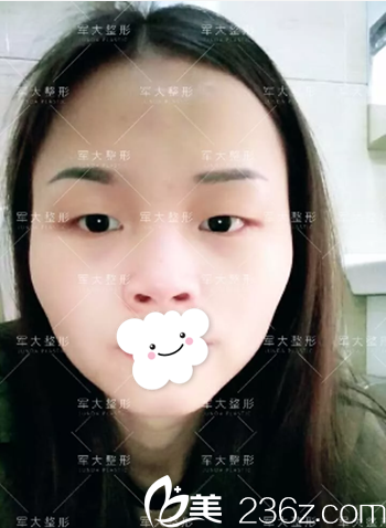 全切双眼皮+膨体隆鼻术前照 全切双眼皮+膨体隆鼻术前照